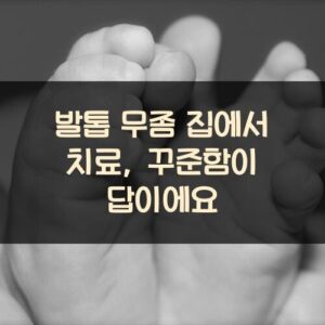 발톱 무좀 집에서 치료, 꾸준함이 답이에요