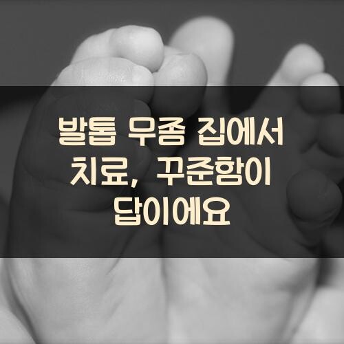 발톱 무좀 집에서 치료, 꾸준함이 답이에요